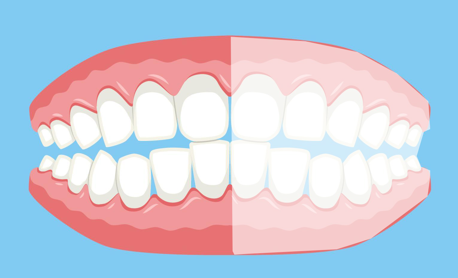 Half_Dentures