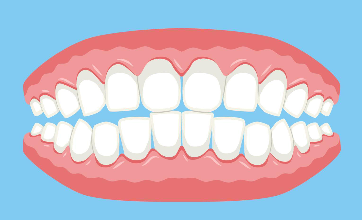 full_denture